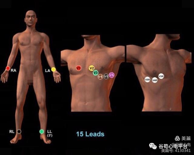 12导、15导、18导连接示意图及心脏各壁超声解剖位置与心电图导联对应关系