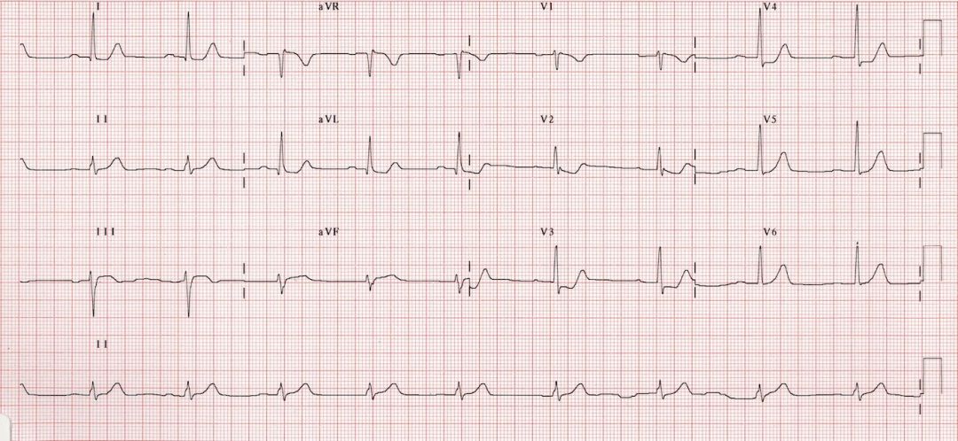 12导、15导、18导连接示意图及心脏各壁超声解剖位置与心电图导联对应关系
