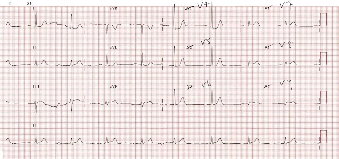 12导、15导、18导连接示意图及心脏各壁超声解剖位置与心电图导联对应关系