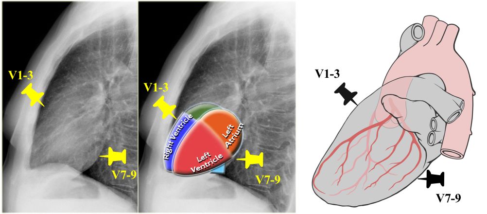 12导、15导、18导连接示意图及心脏各壁超声解剖位置与心电图导联对应关系