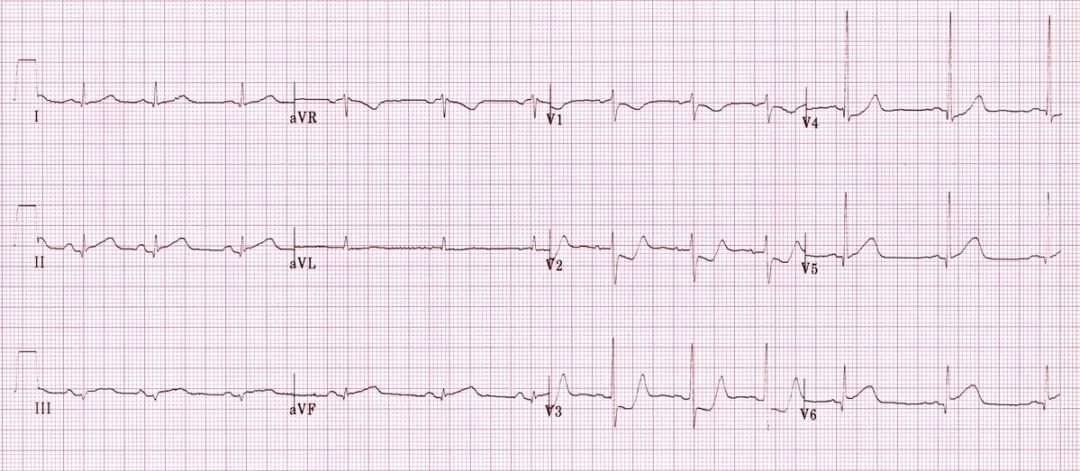 12导、15导、18导连接示意图及心脏各壁超声解剖位置与心电图导联对应关系