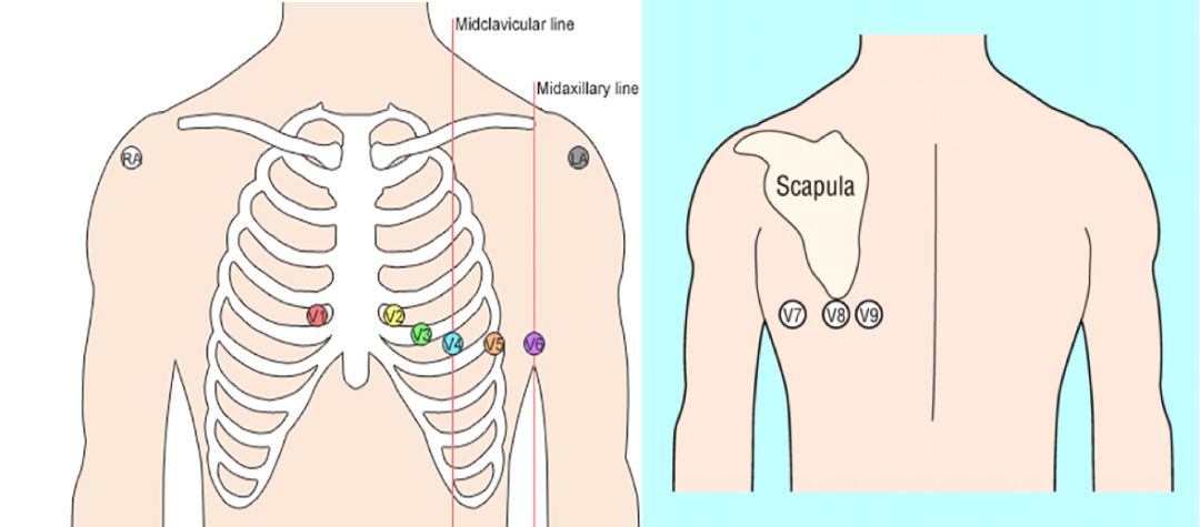 12导、15导、18导连接示意图及心脏各壁超声解剖位置与心电图导联对应关系