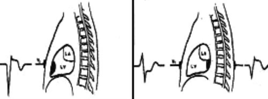 12导、15导、18导连接示意图及心脏各壁超声解剖位置与心电图导联对应关系