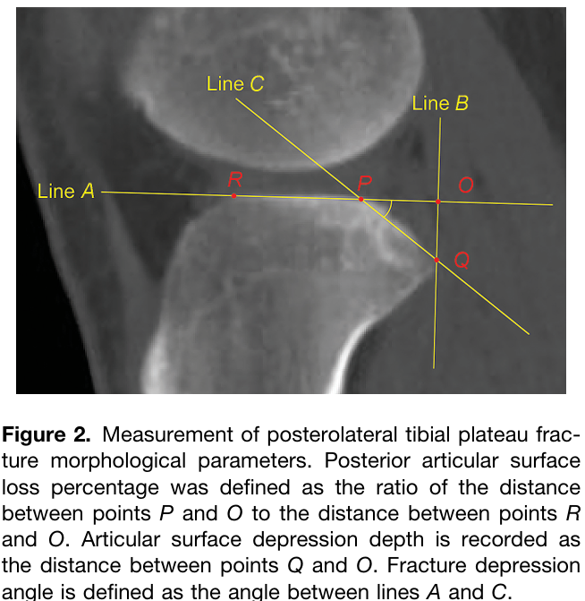 【一文综述】了解胫骨平台骨折的复位标准