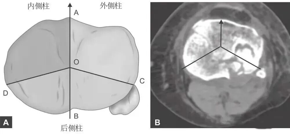【一文综述】了解胫骨平台骨折的复位标准