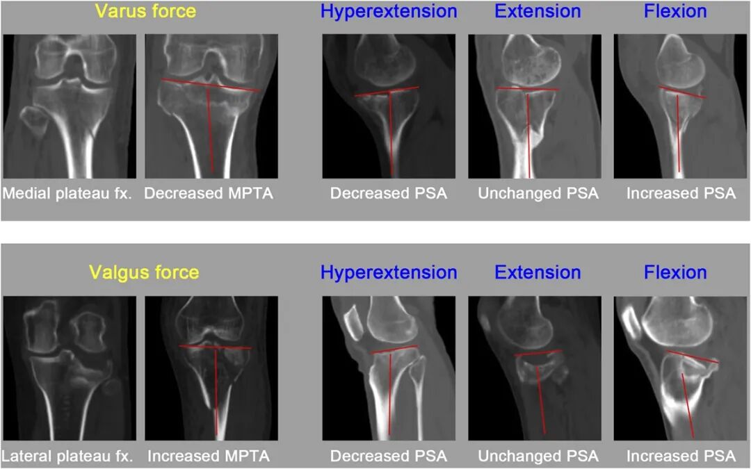 【一文综述】了解胫骨平台骨折的复位标准