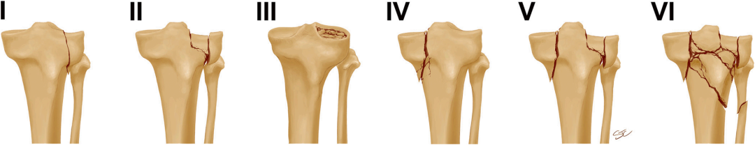 【一文综述】了解胫骨平台骨折的复位标准