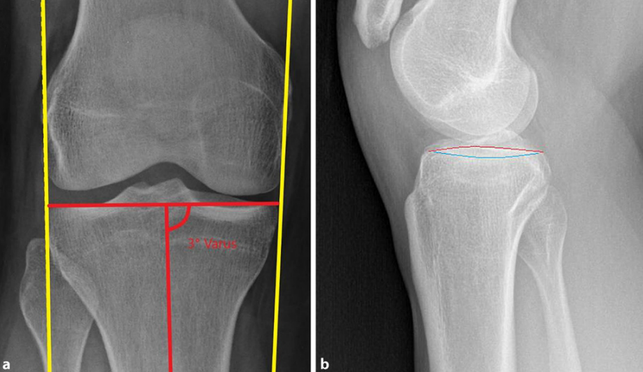 【一文综述】了解胫骨平台骨折的复位标准