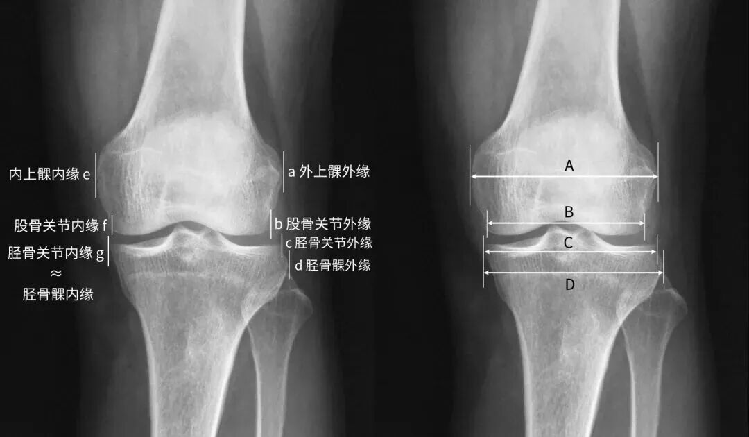 【一文综述】了解胫骨平台骨折的复位标准