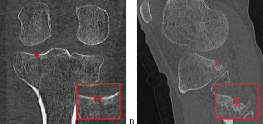 【一文综述】了解胫骨平台骨折的复位标准