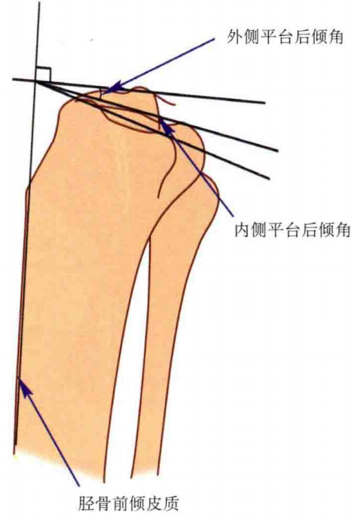 【一文综述】了解胫骨平台骨折的复位标准