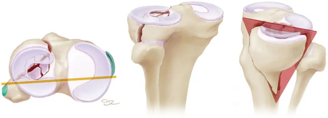 【一文综述】了解胫骨平台骨折的复位标准