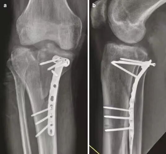 【一文综述】了解胫骨平台骨折的复位标准