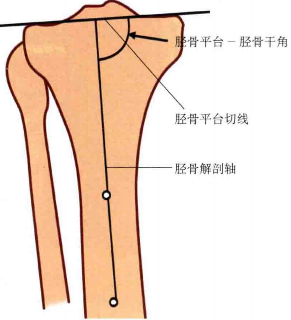 【一文综述】了解胫骨平台骨折的复位标准