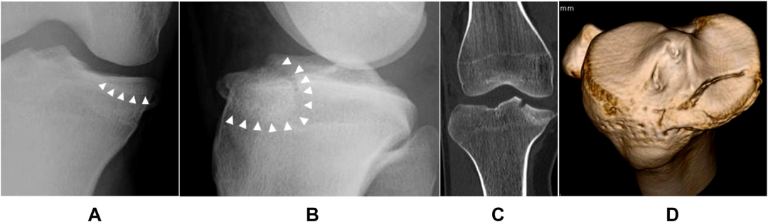 【一文综述】了解胫骨平台骨折的复位标准