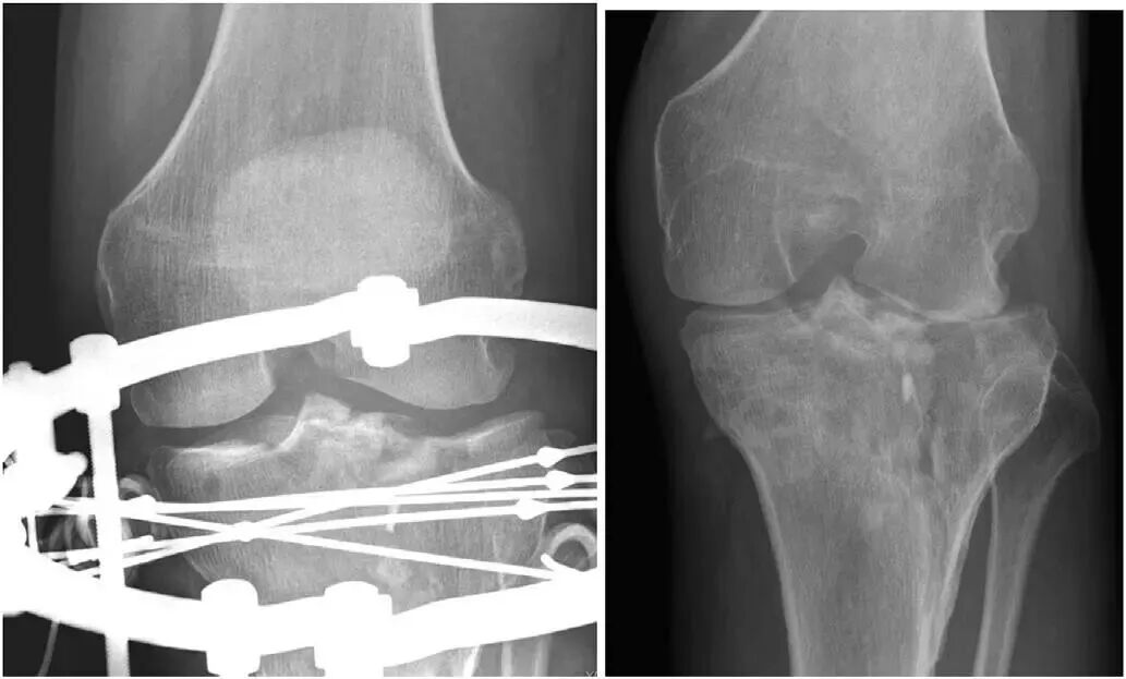 【一文综述】了解胫骨平台骨折的复位标准
