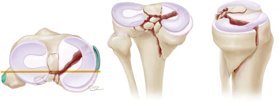 【一文综述】了解胫骨平台骨折的复位标准