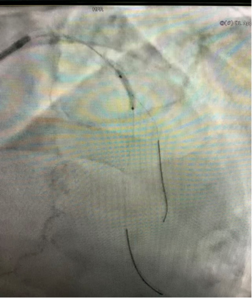 一文读懂冠脉分叉病变的临床处理策略：精准介入，优化治疗