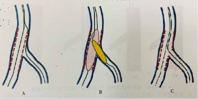 一文读懂冠脉分叉病变的临床处理策略：精准介入，优化治疗