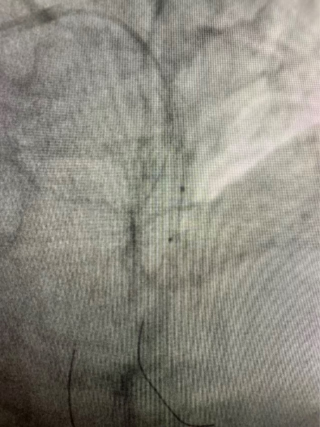一文读懂冠脉分叉病变的临床处理策略：精准介入，优化治疗