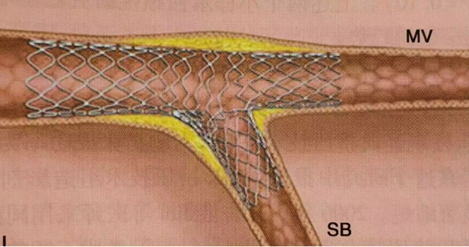 一文读懂冠脉分叉病变的临床处理策略：精准介入，优化治疗