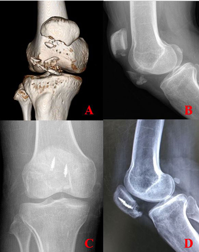 髌骨下极粉碎性骨折的缝线桥锚钉固定技术
