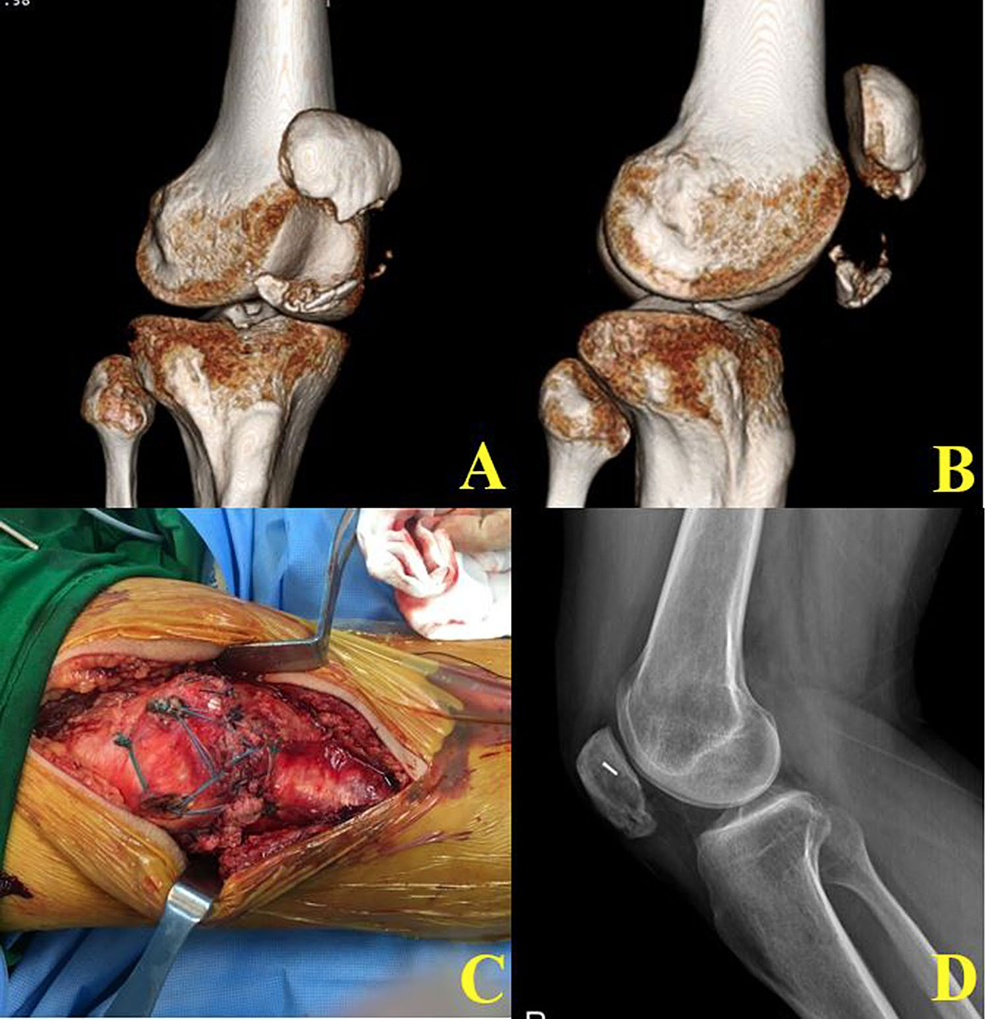 髌骨下极粉碎性骨折的缝线桥锚钉固定技术