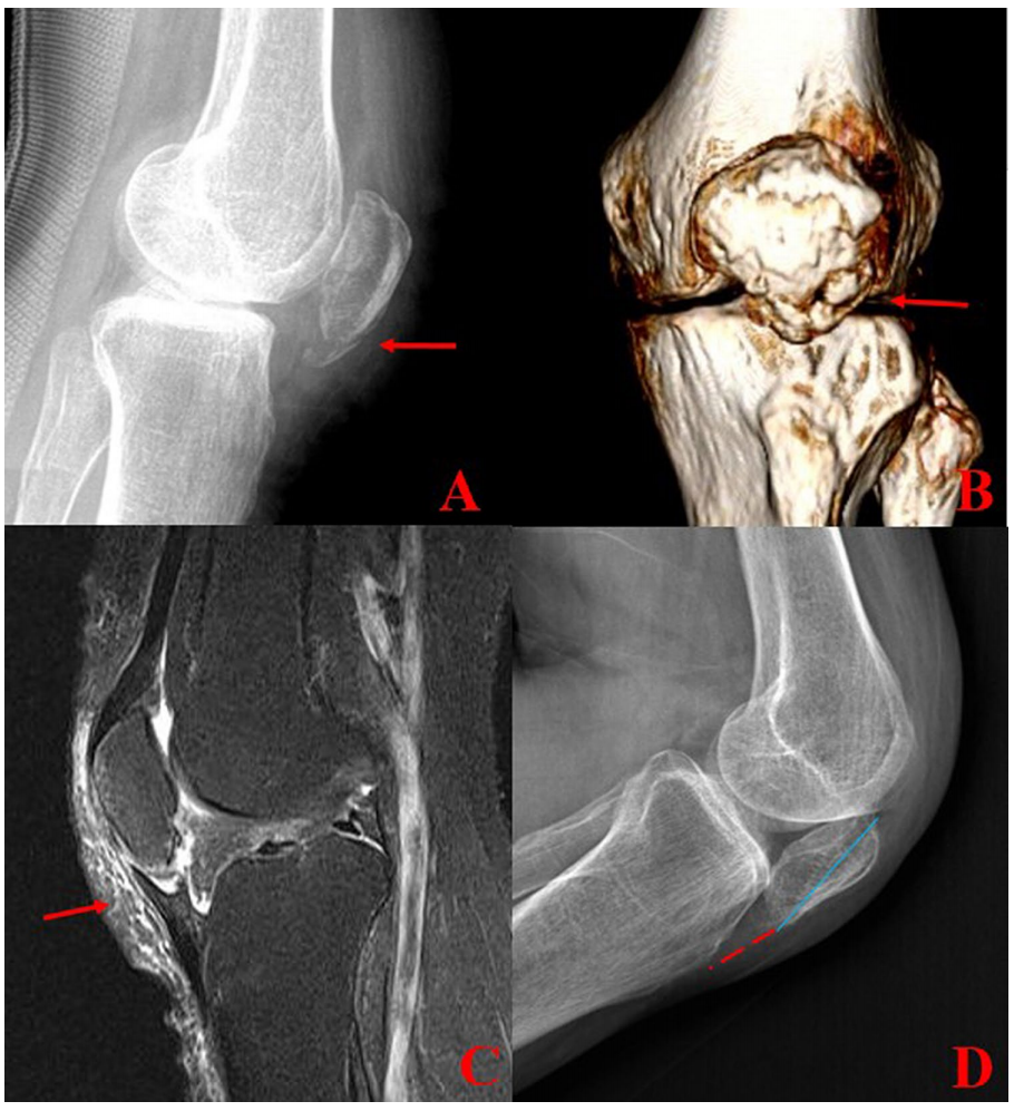 髌骨下极粉碎性骨折的缝线桥锚钉固定技术