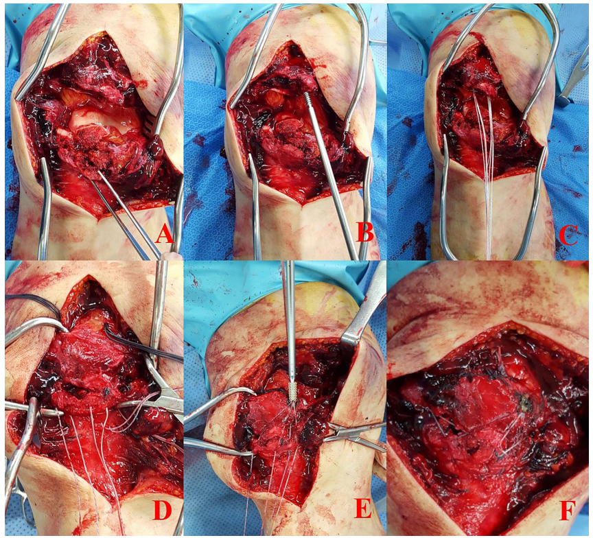 髌骨下极粉碎性骨折的缝线桥锚钉固定技术