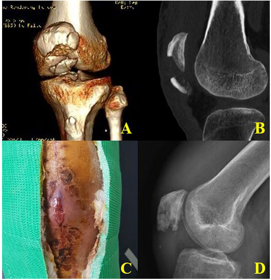 髌骨下极粉碎性骨折的缝线桥锚钉固定技术
