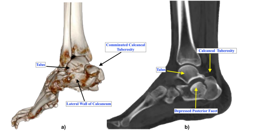 【手术技巧】跟骨骨折经皮复位新技术(印度经验)