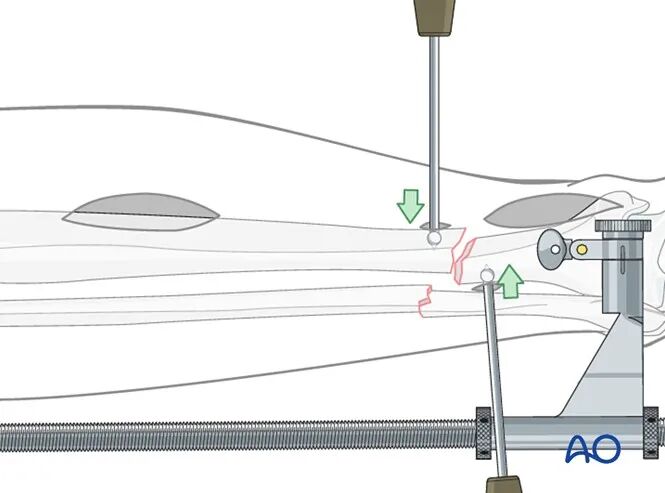 胫骨简单横形骨折的MIPO加压钢板内固定AO指南
