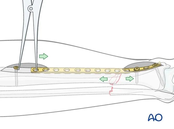 胫骨简单横形骨折的MIPO加压钢板内固定AO指南
