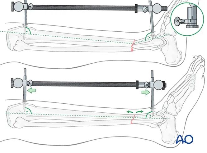 胫骨简单横形骨折的MIPO加压钢板内固定AO指南