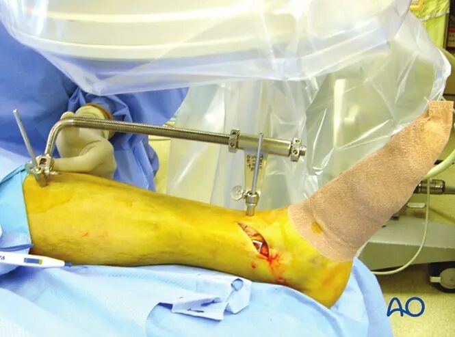 胫骨简单横形骨折的MIPO加压钢板内固定AO指南