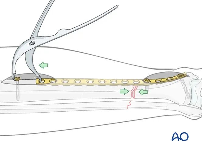 胫骨简单横形骨折的MIPO加压钢板内固定AO指南