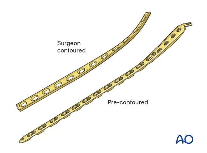 胫骨简单横形骨折的MIPO加压钢板内固定AO指南
