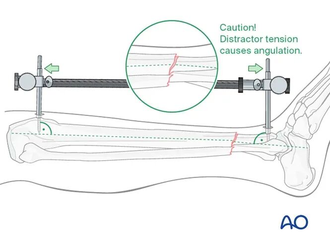 胫骨简单横形骨折的MIPO加压钢板内固定AO指南