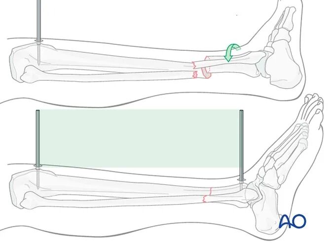 胫骨简单横形骨折的MIPO加压钢板内固定AO指南