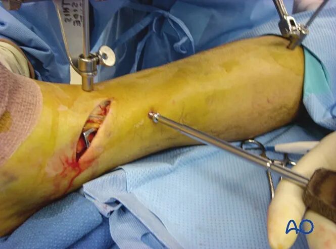 胫骨简单横形骨折的MIPO加压钢板内固定AO指南