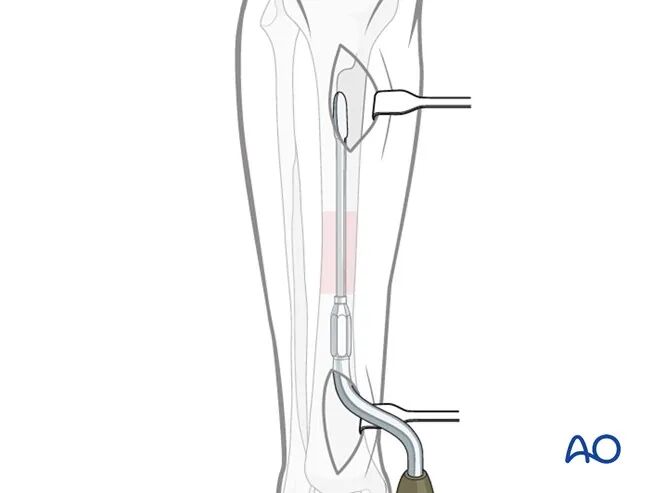 胫骨简单横形骨折的MIPO加压钢板内固定AO指南