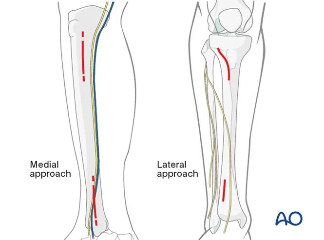 胫骨简单横形骨折的MIPO加压钢板内固定AO指南