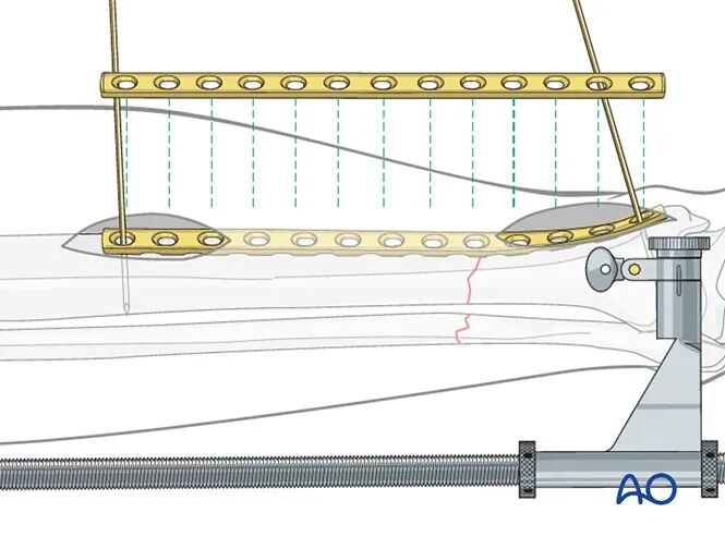 胫骨简单横形骨折的MIPO加压钢板内固定AO指南