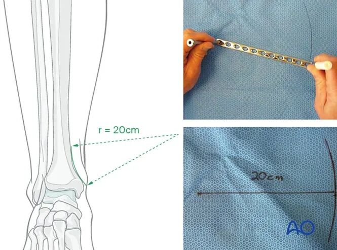 胫骨简单横形骨折的MIPO加压钢板内固定AO指南