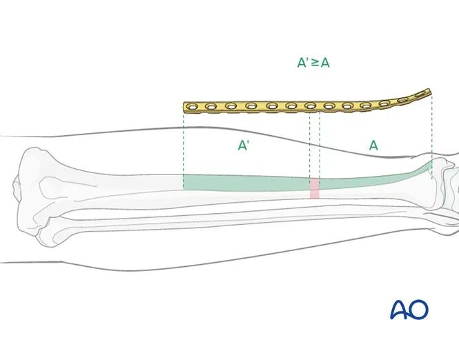 胫骨简单横形骨折的MIPO加压钢板内固定AO指南