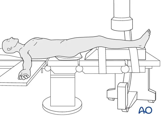 胫骨简单横形骨折的MIPO加压钢板内固定AO指南