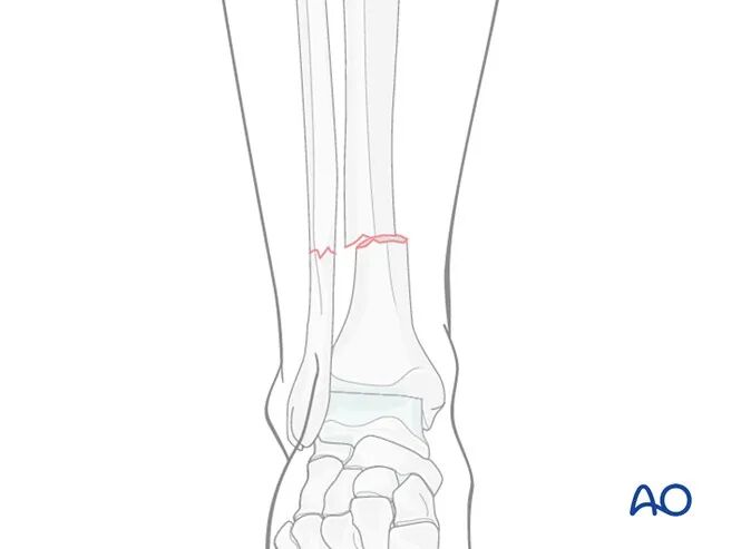胫骨简单横形骨折的MIPO加压钢板内固定AO指南