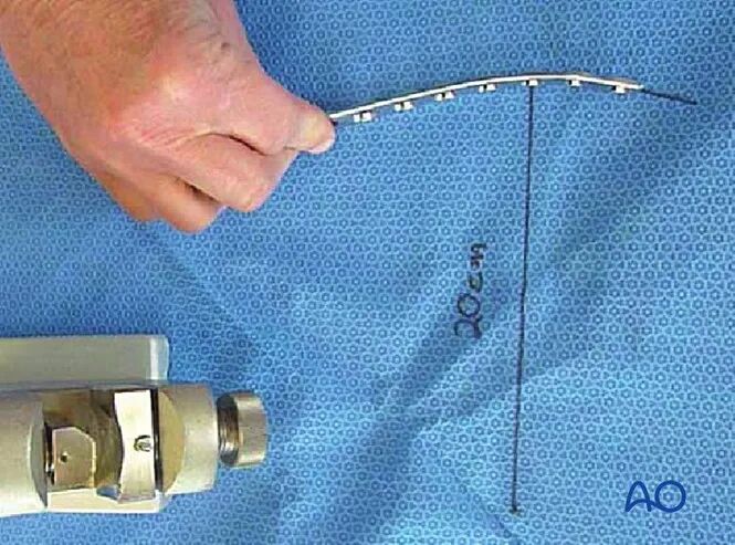 胫骨简单横形骨折的MIPO加压钢板内固定AO指南