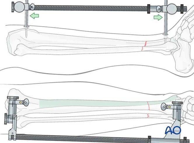 胫骨简单横形骨折的MIPO加压钢板内固定AO指南
