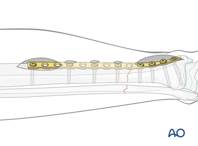 胫骨简单横形骨折的MIPO加压钢板内固定AO指南